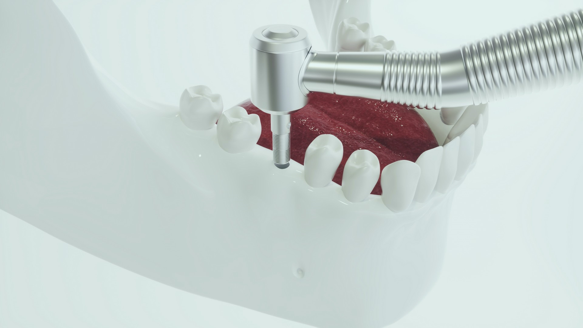 Implantología en Menorca