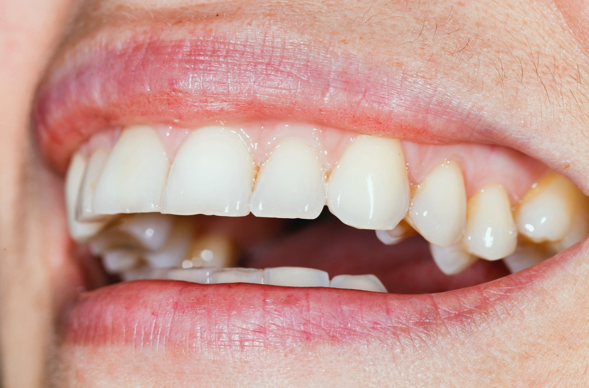 Periodoncia en Menorca