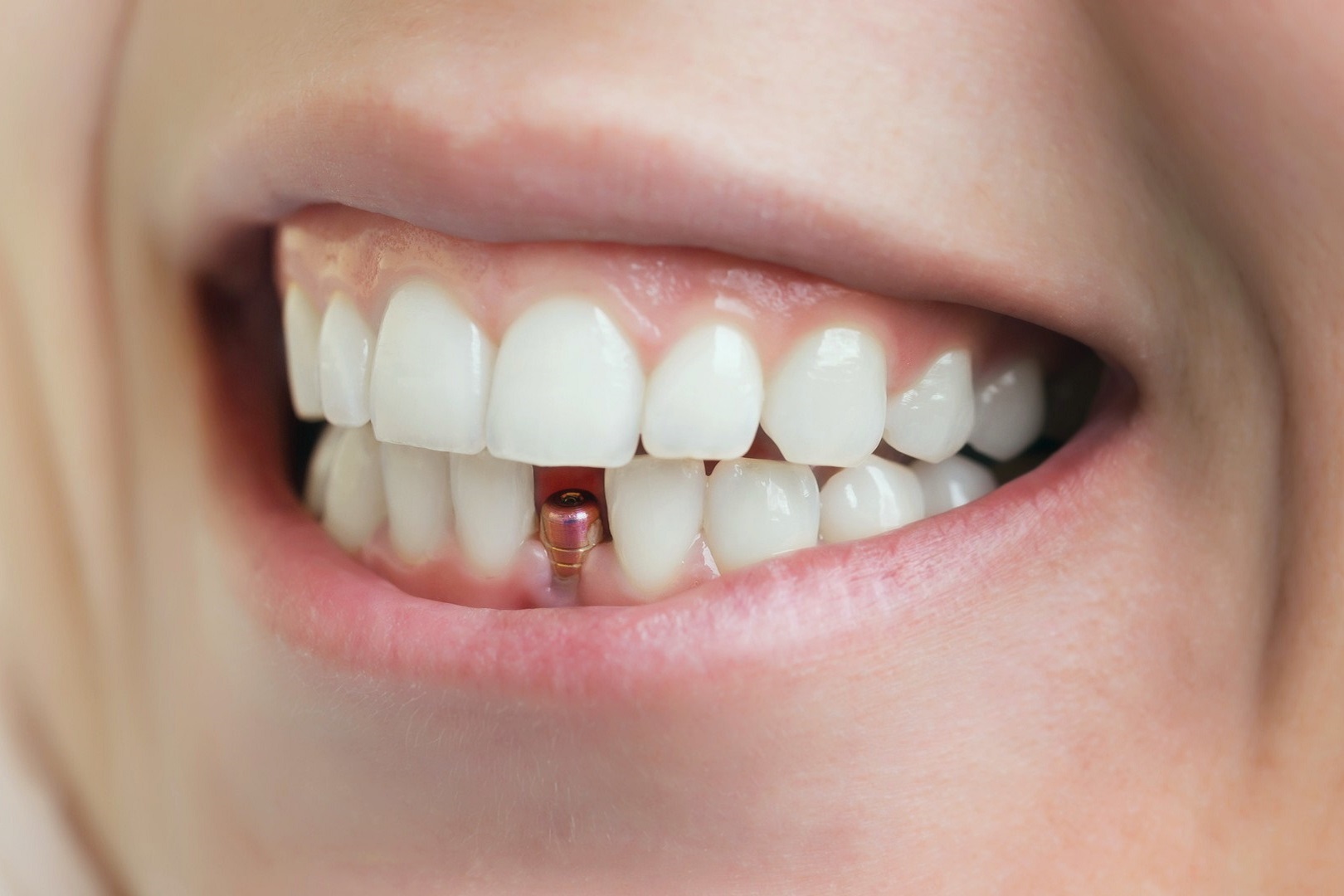 Implantes dentales Mahón