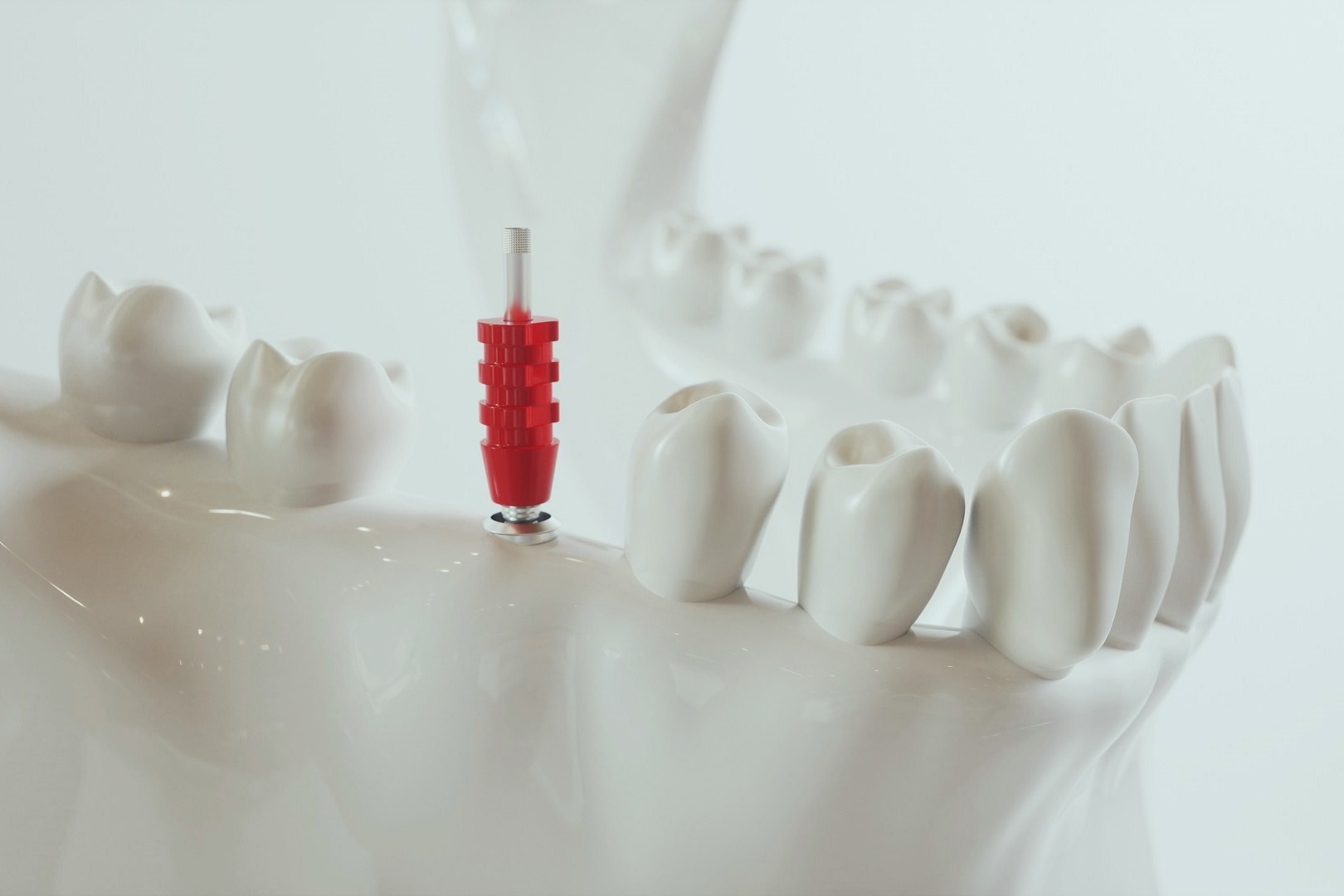 Implantes dentales Menorca
