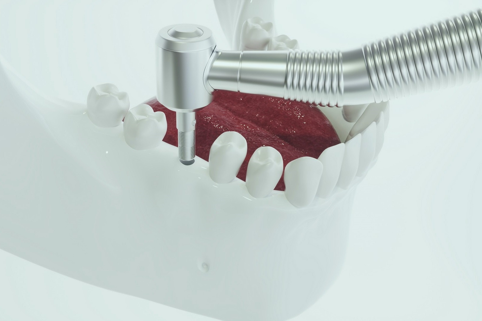 Implantología en Menorca
