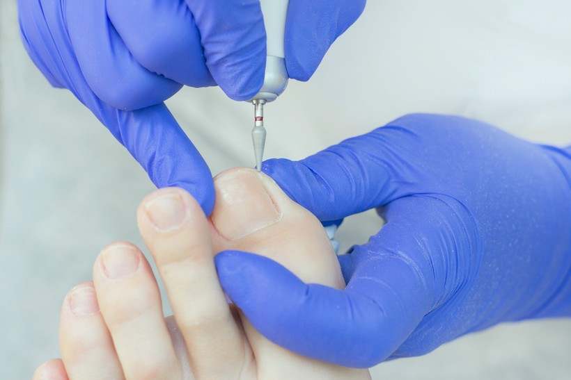 CIRUGÍA UNGUEAL en Menorca