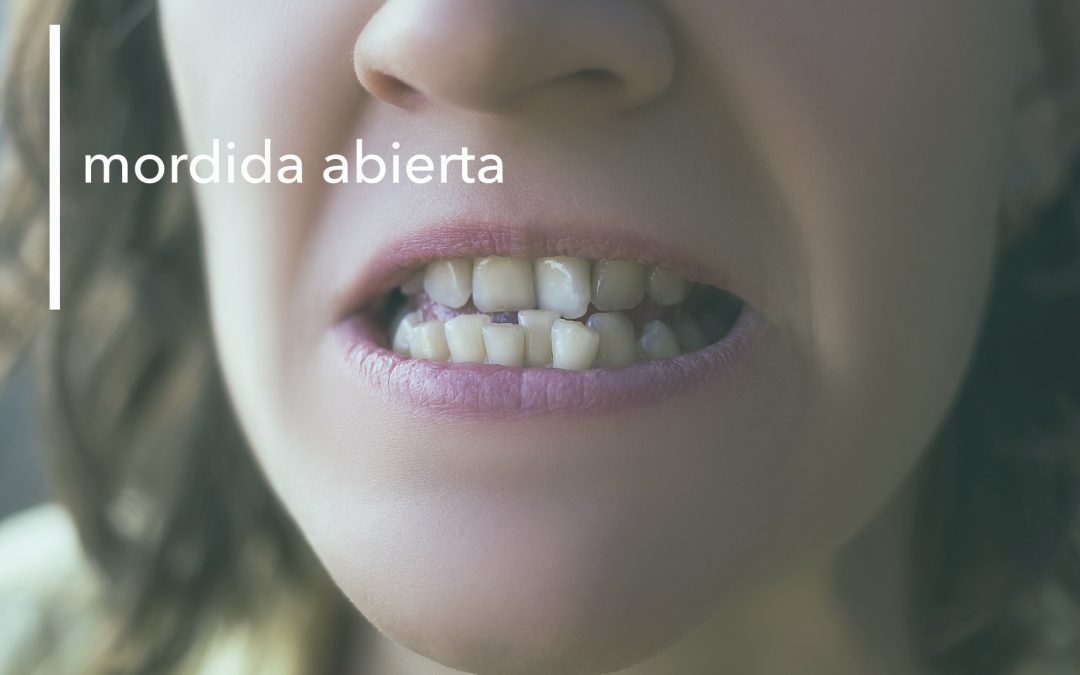 PROBLEMAS DE MORDIDA ABIERTA EN MENORCA