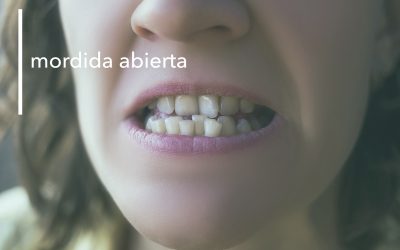 PROBLEMAS DE MORDIDA ABIERTA EN MENORCA