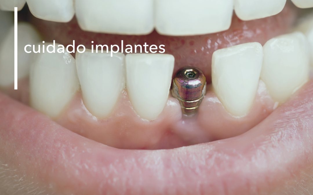 EL CUIDADO DE LOS IMPLANTES DENTALES EN MENORCA
