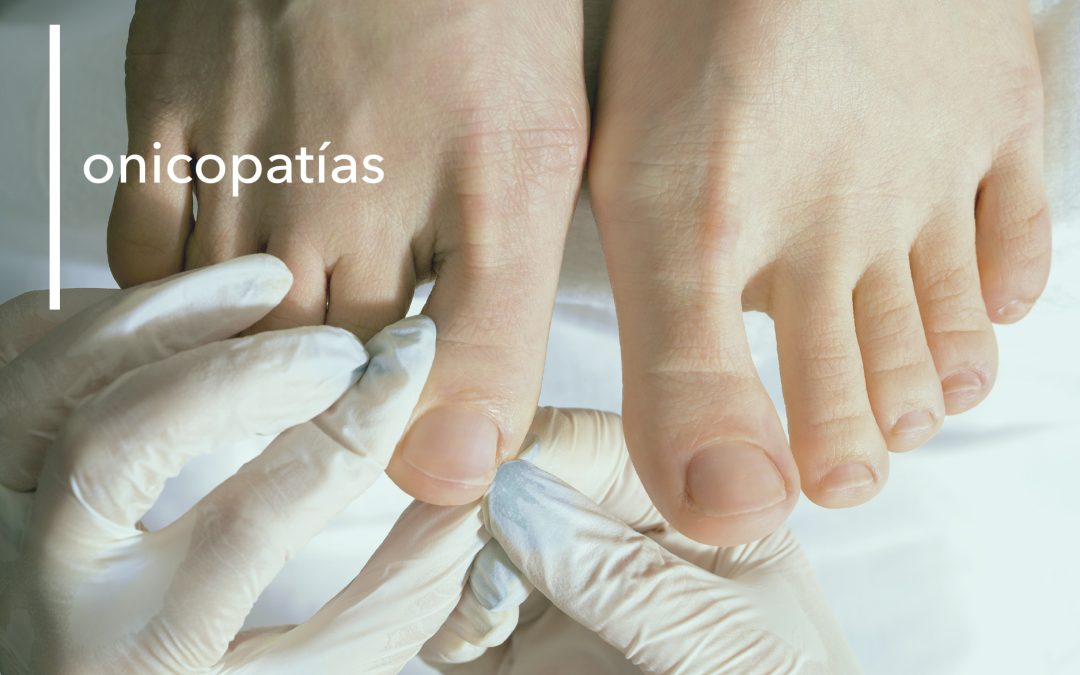 ONICOPATÍAS EN MENORCA