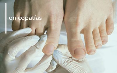 ONICOPATÍAS EN MENORCA