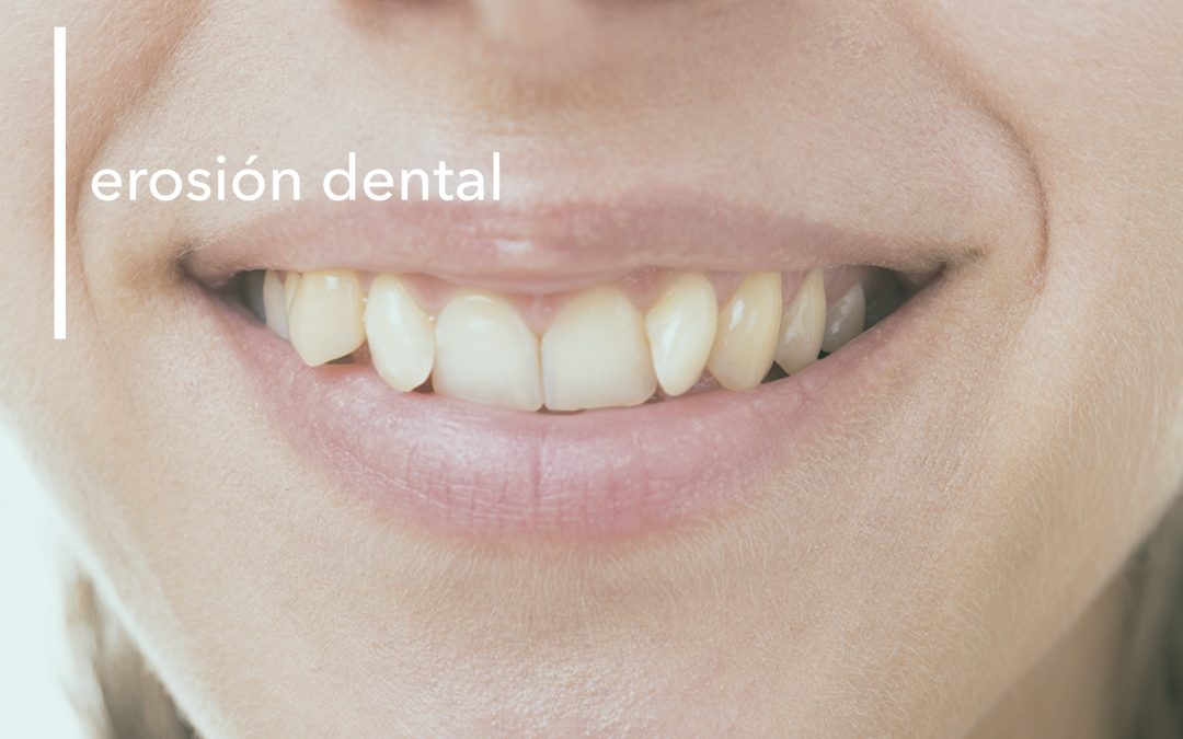 LA EROSIÓN DENTAL