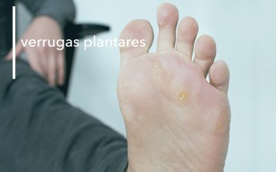 VERRUGAS PLANTARES