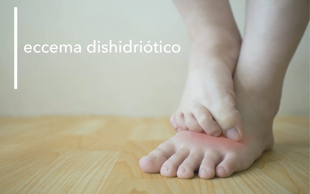 ECCEMA DISHIDRIÓTICO