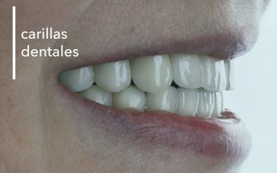 CARILLAS DENTALES