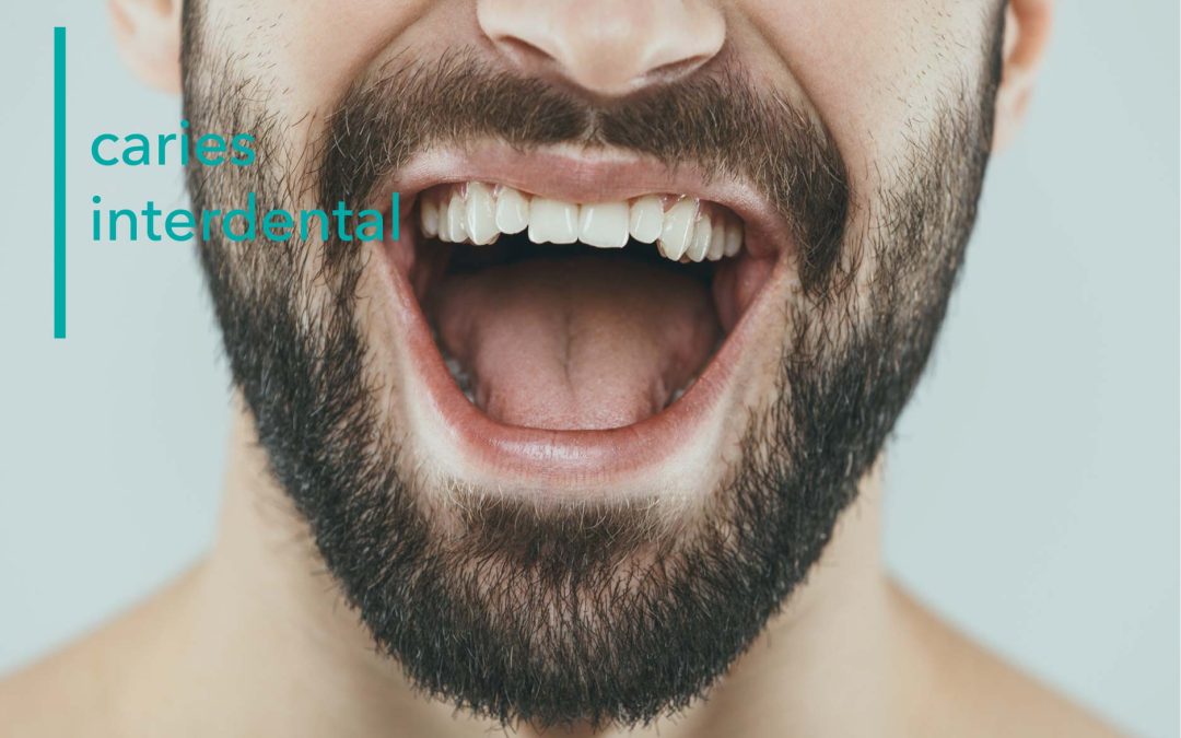 PREVENCIÓN CARIES INTERDENTAL EN MENORCA