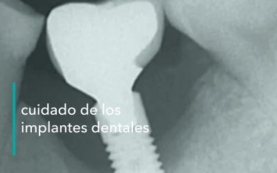 LA IMPORTANCIA DEL CUIDADO DE LOS IMPLANTES DENTALES