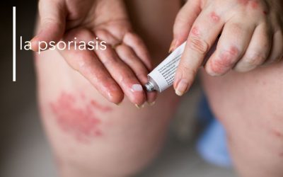 LA PSORIASIS