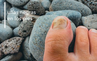 CAUSAS Y SOLUCIONES PARA LAS UÑAS NEGRAS EN LOS PIES
