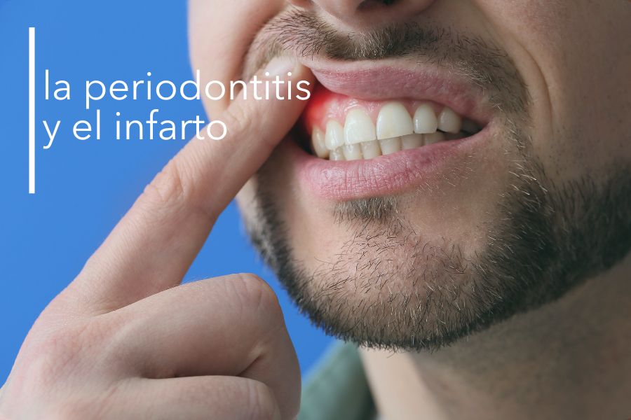 LA RELACIÓN ENTRE LA PERIODONTITIS Y EL INFARTO